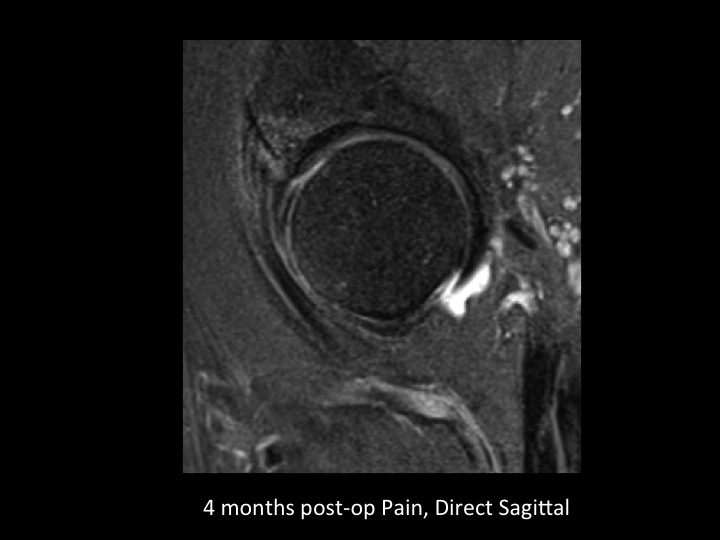 Figure 3 for case acetabular labrum ( RID2644 )